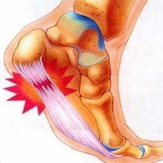 Flat Feet, Plantar Fasciitis, and Foot Pain: How Physical Therapy Can Help